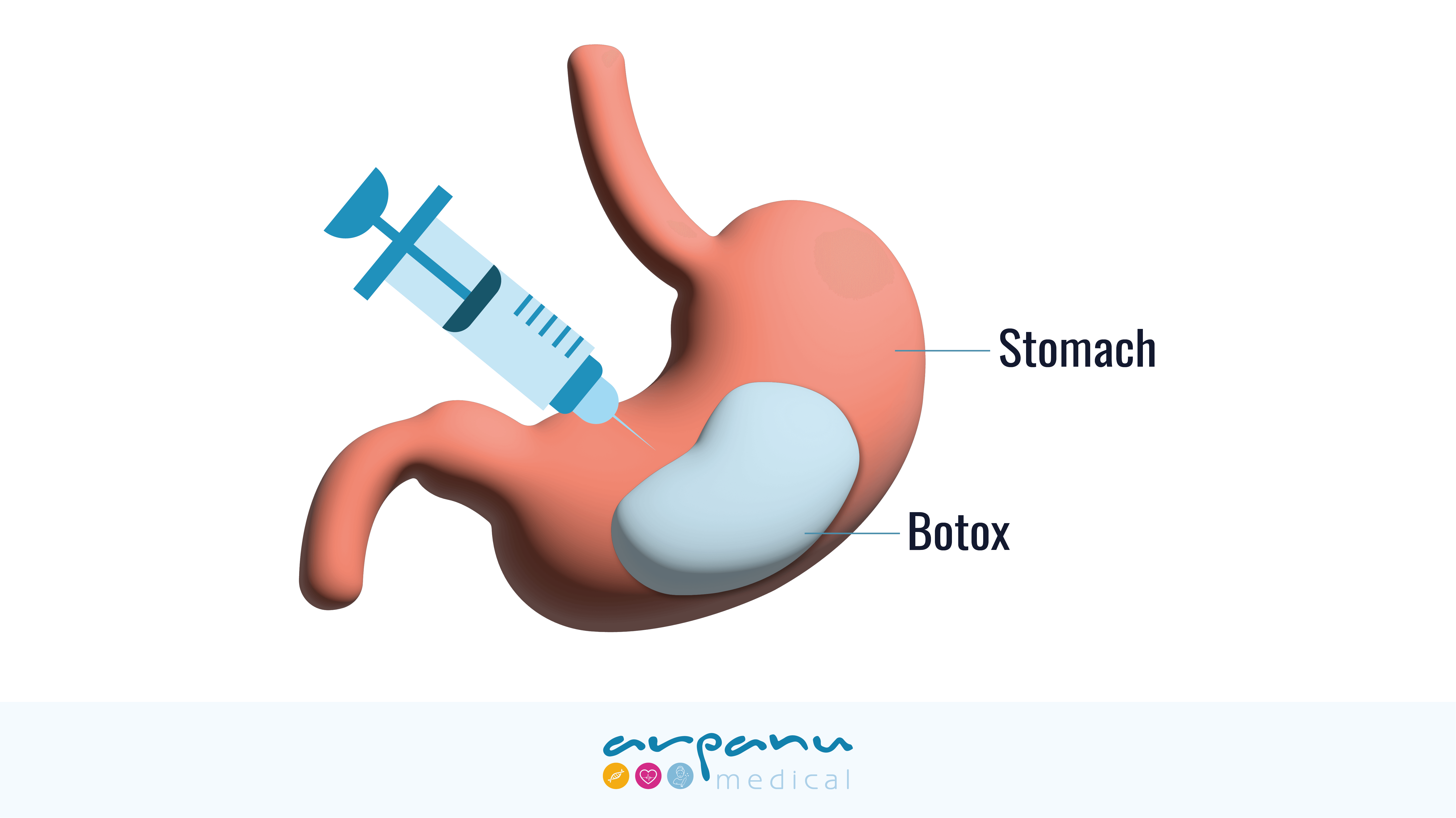 Gastric Botox in Turkey, a Popular Treatment for Obesity