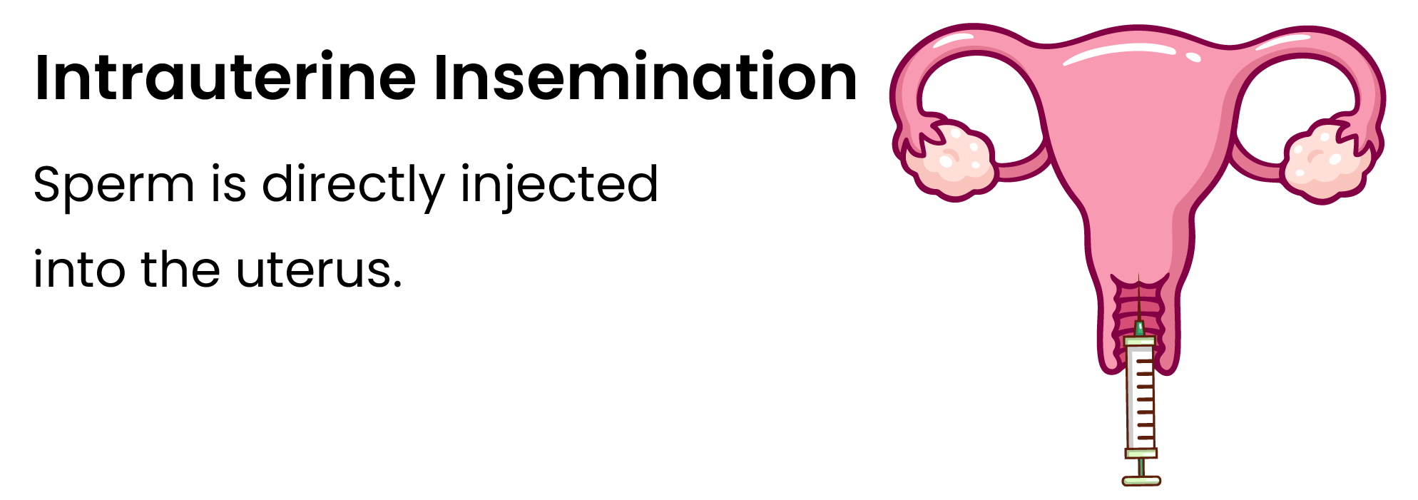 Intrauterine-Insemination