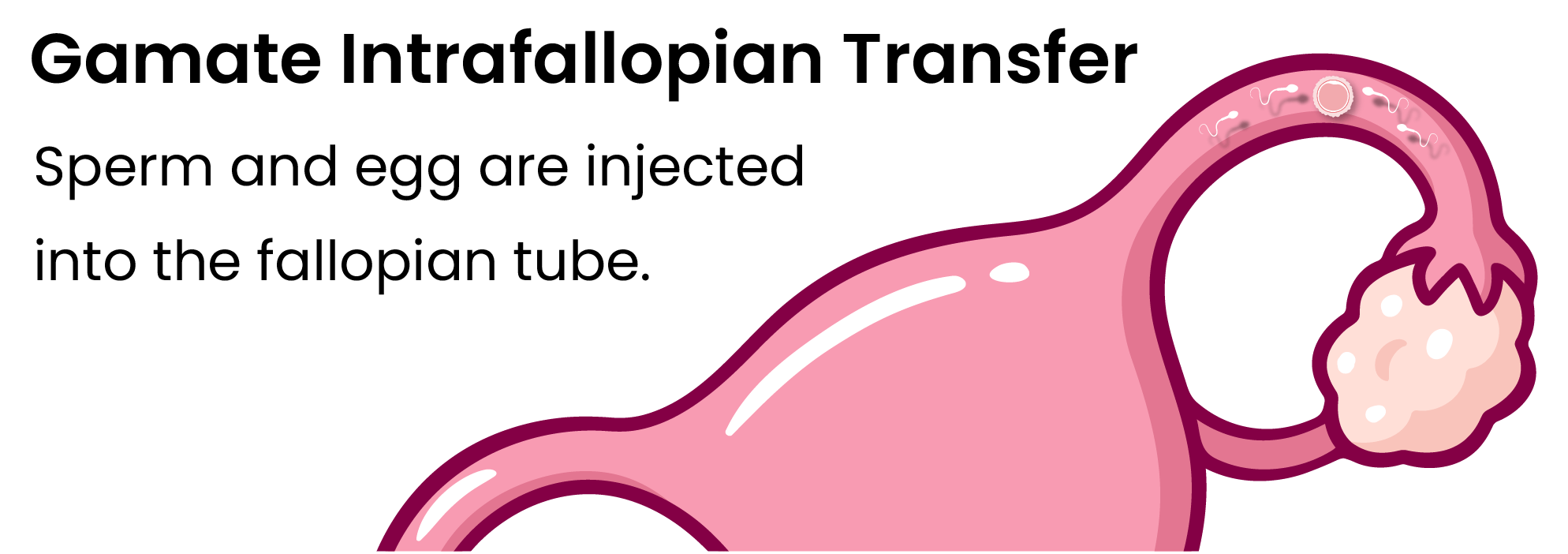 gamate-intrafallopian-transfer