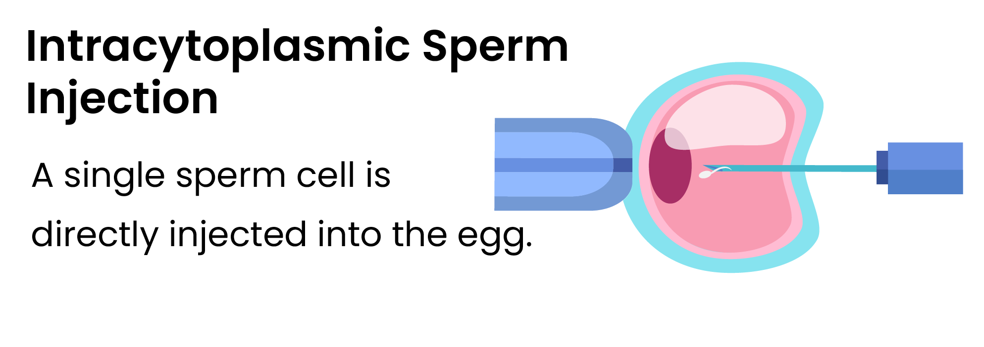 intracytoplasmic-sperm-injection