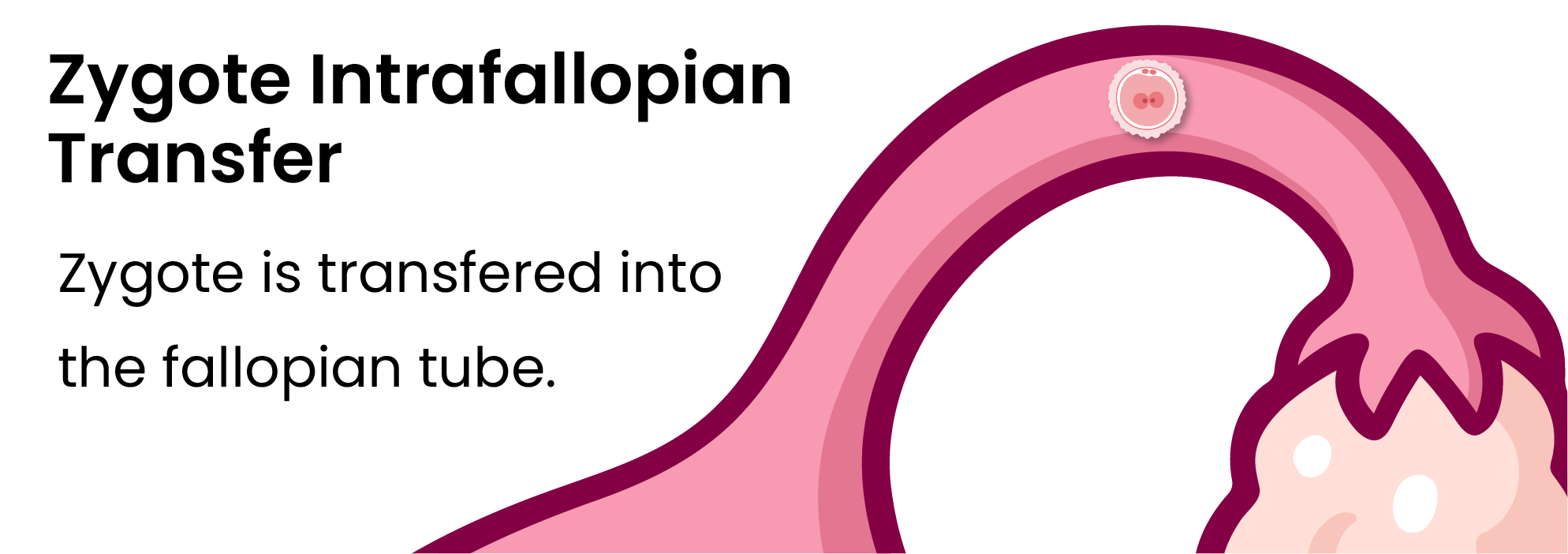 zygote-intrafallopian-transfer